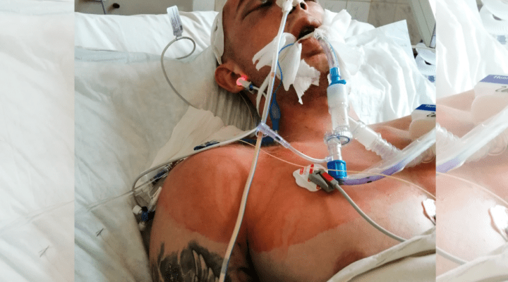 Mężczyzna leżący w szpitalnym łóżku z maską tlenu.